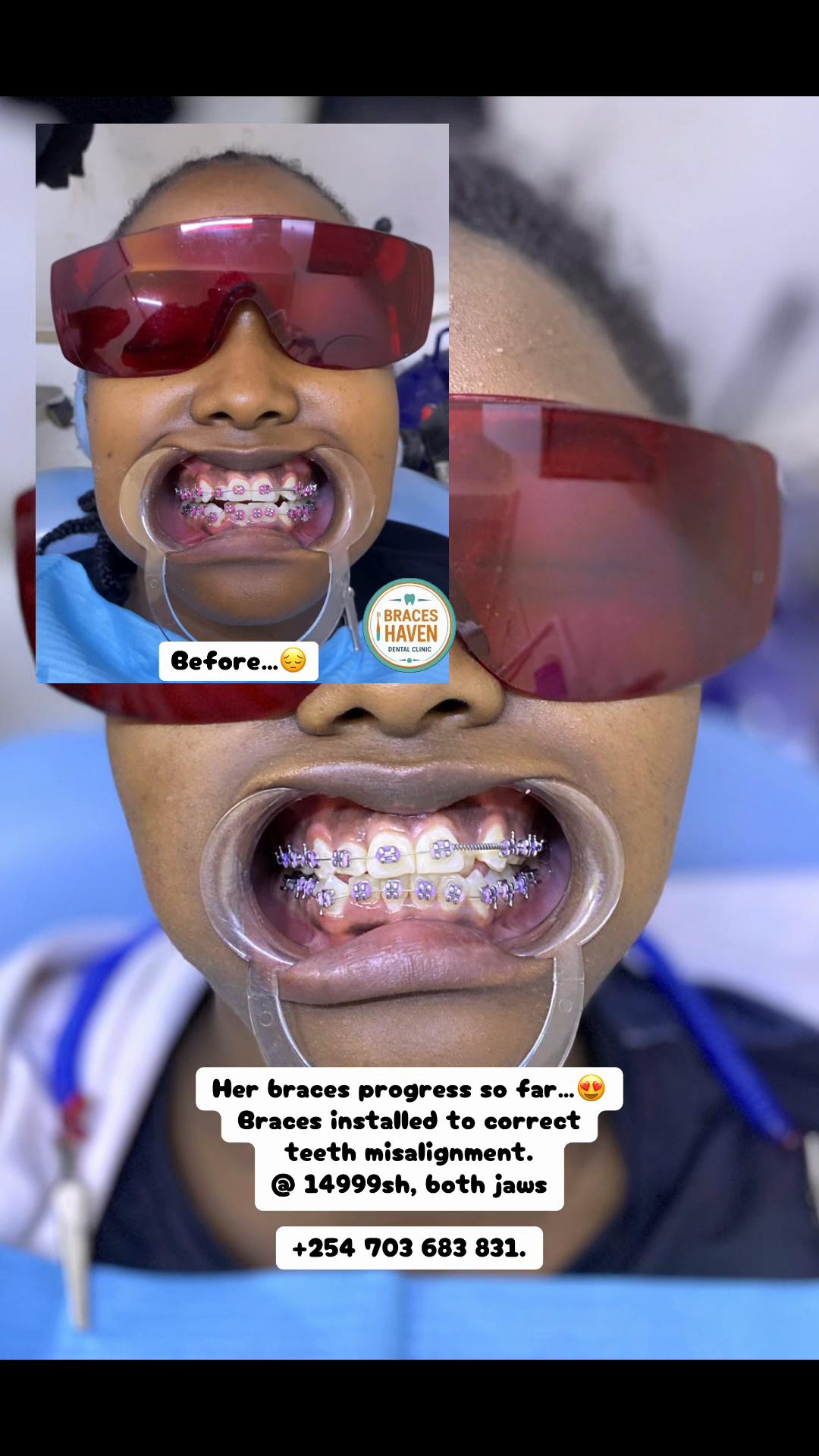 @Braces Haven Nairobi Dental