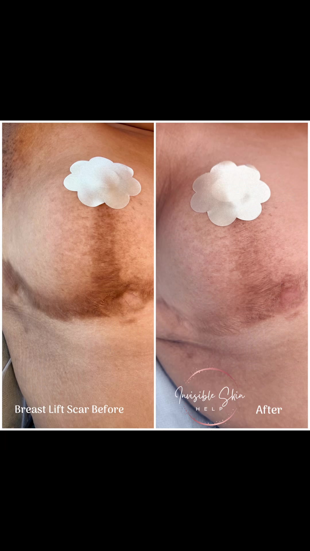 @Invisibleskinhelp