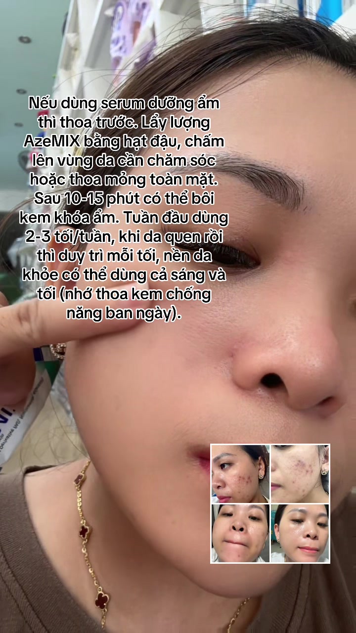 @Hoa Acne Skincare🌷