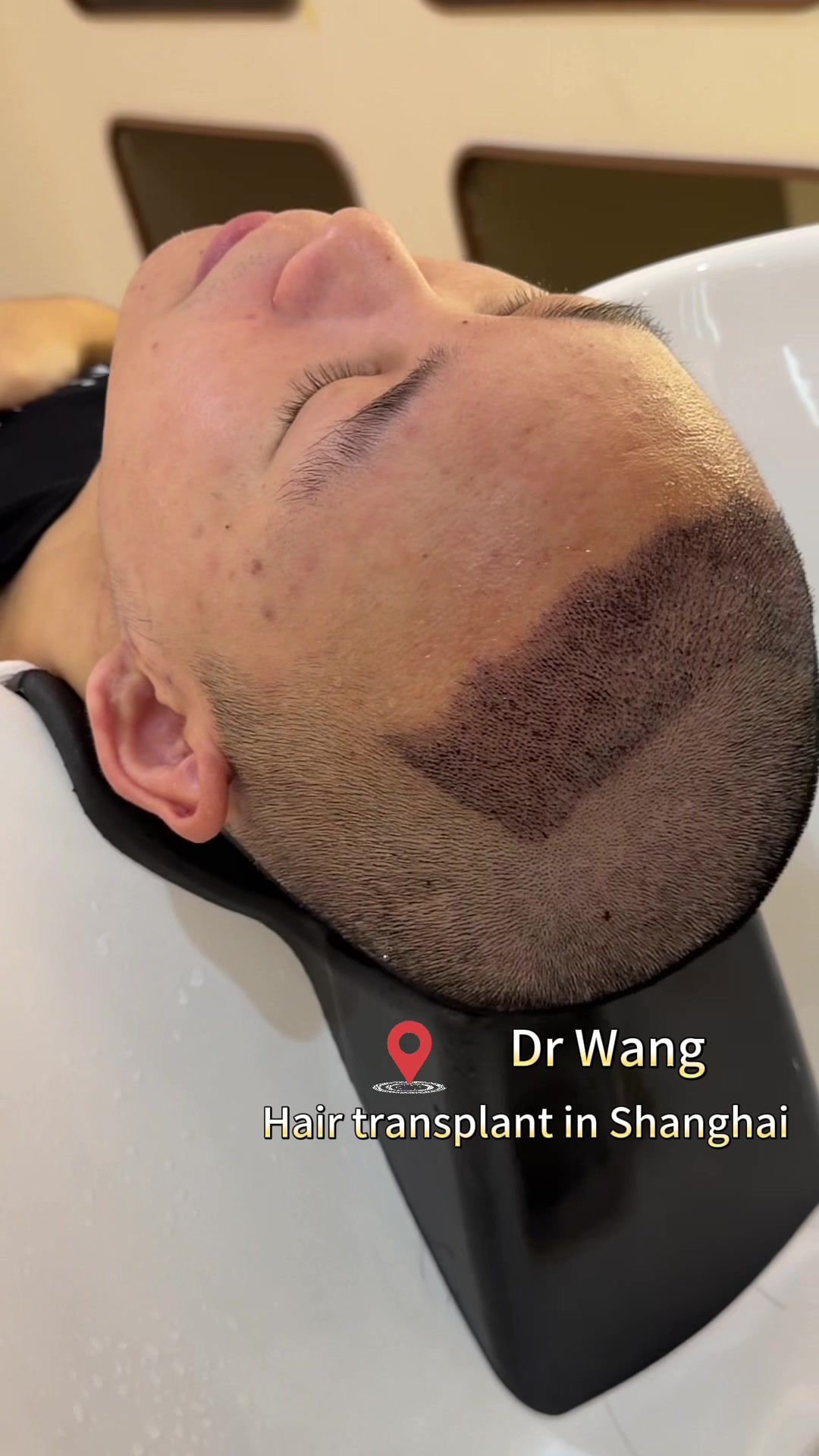 @HAIR TRANSPLANT WANG🇨🇳