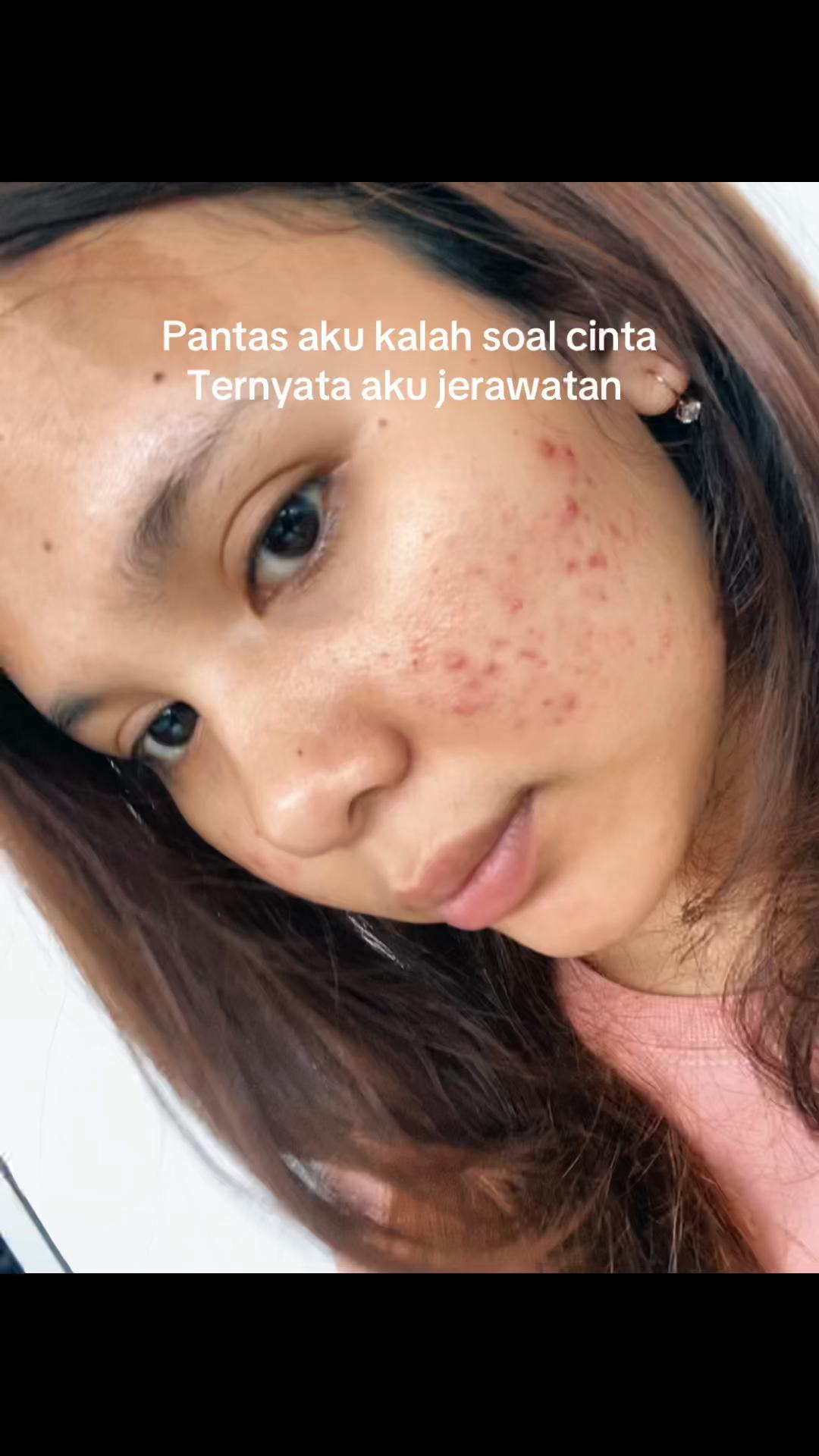 @Natha | Acne fighter