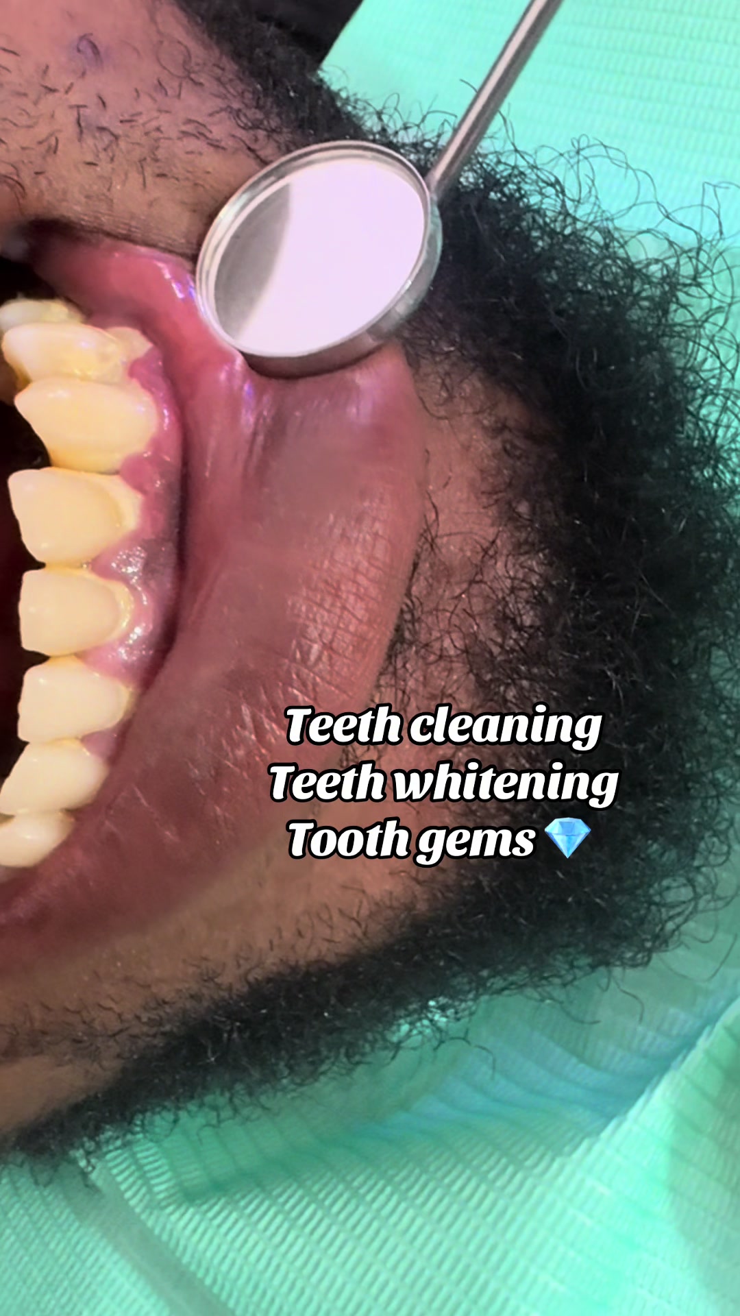 @Teethwhitening—MartGlow Avenue