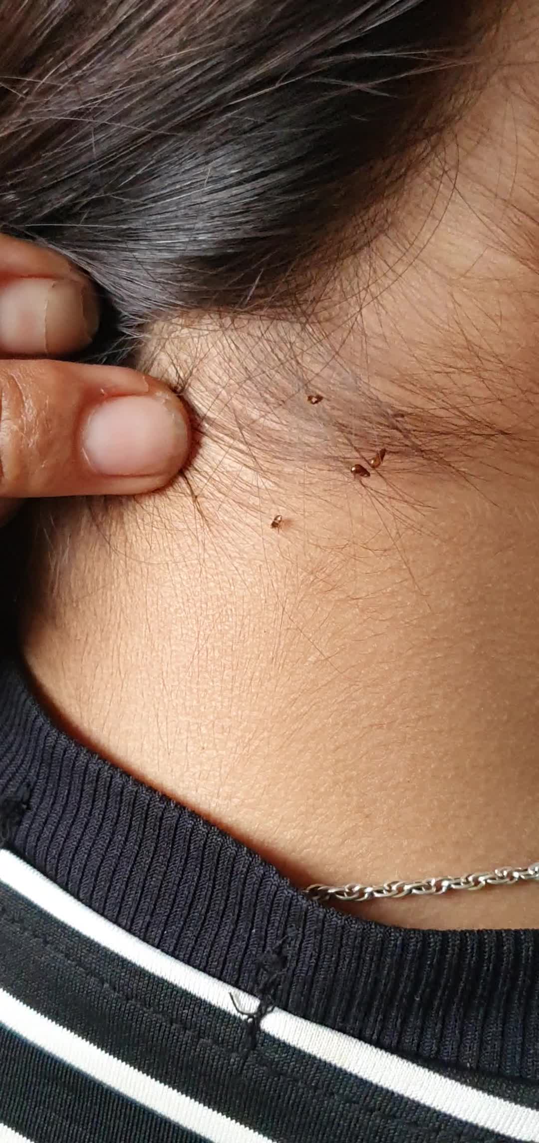 @LICE - TICKS