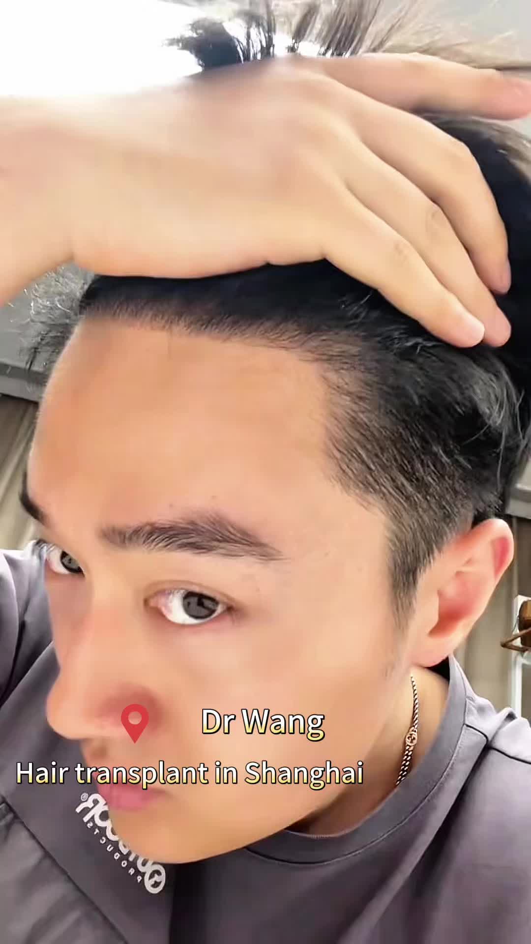 @HAIR TRANSPLANT WANG🇨🇳
