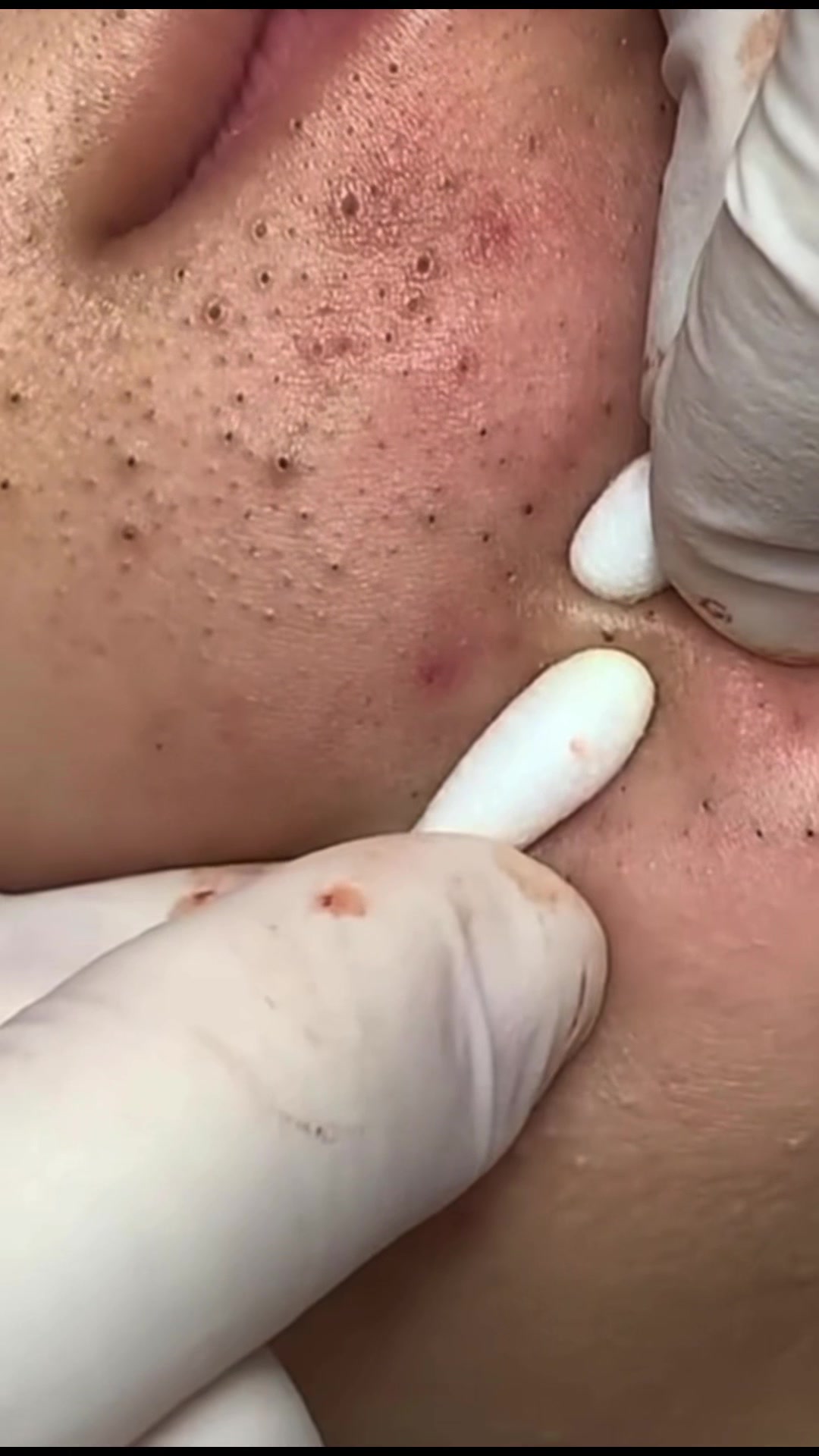 @pimplepopperasmr
