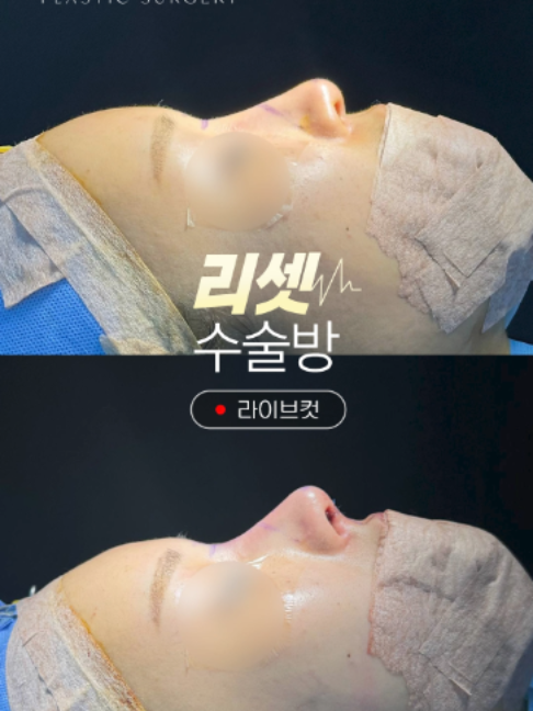 @리셋성형외과