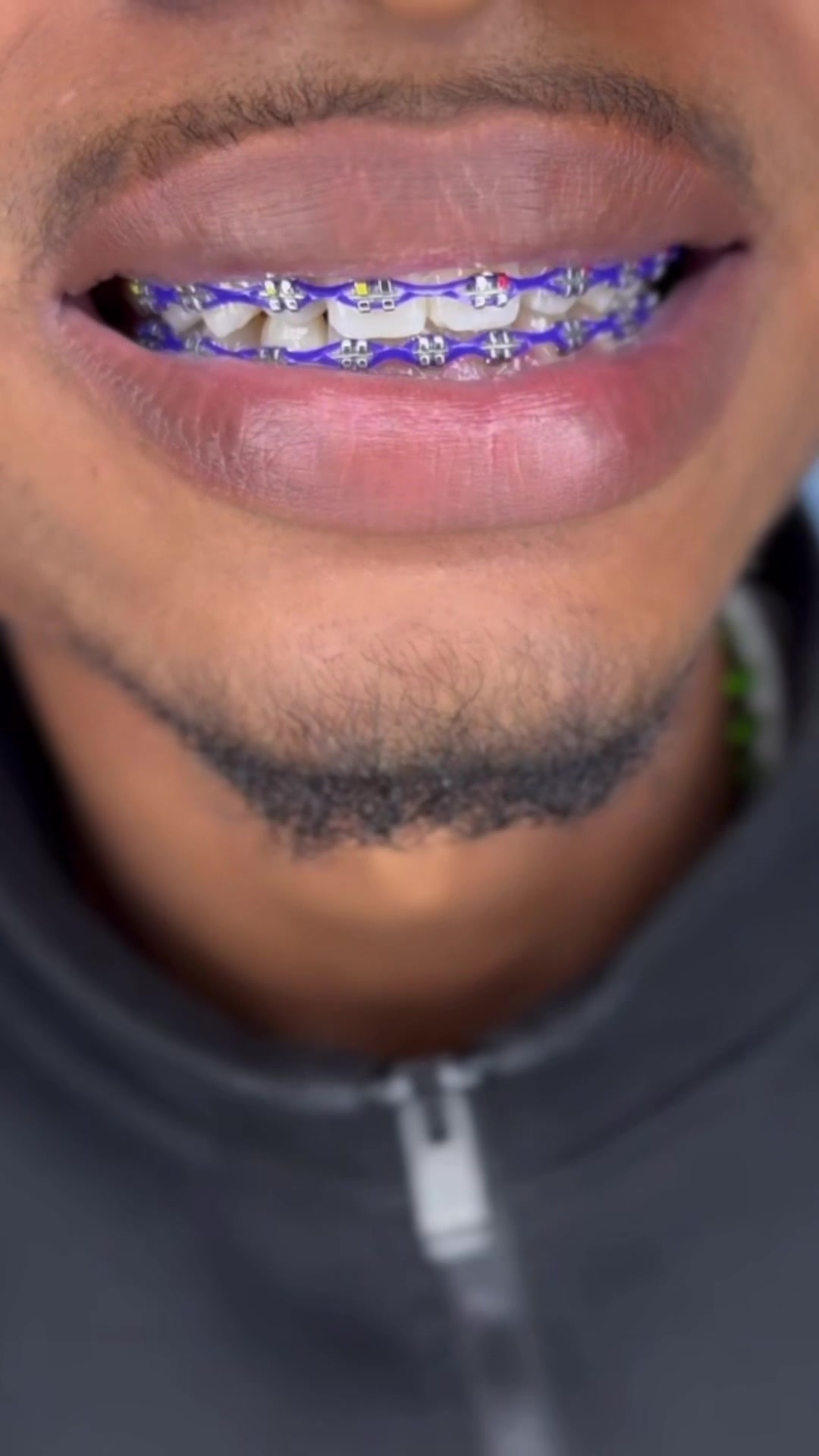 @bracesjunkie