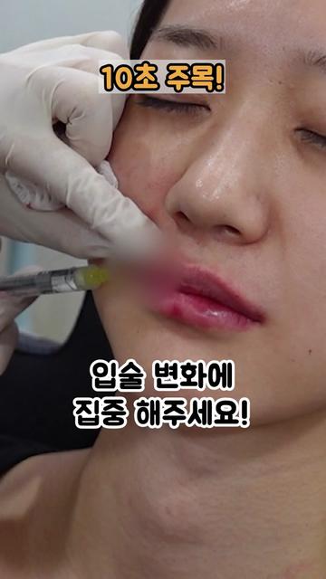 @금손닥터 이현주 Dr.GOLD_FILLER