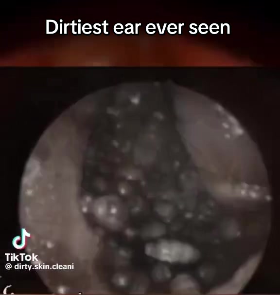@Satisfying Ear Cleaning Videos