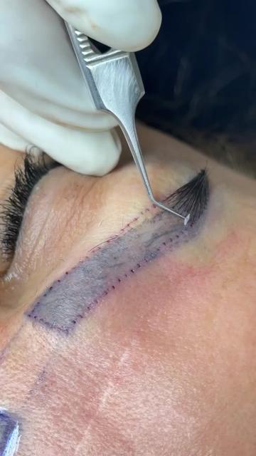 @Eyebrows Transplant