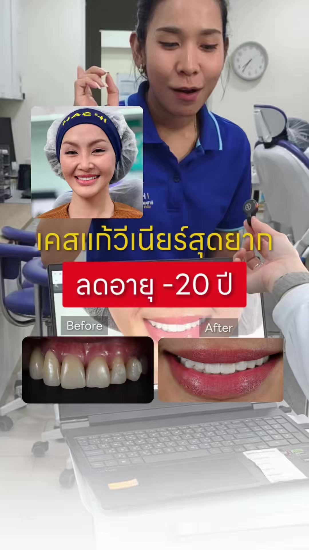 @หมอป่องสวยมาก veneer 🦷