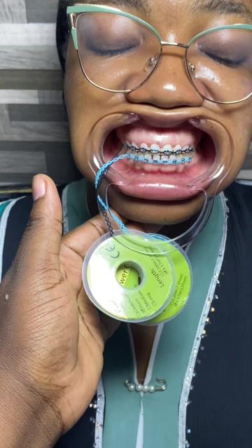 @Braces.bymavi|Smile Aesthetics