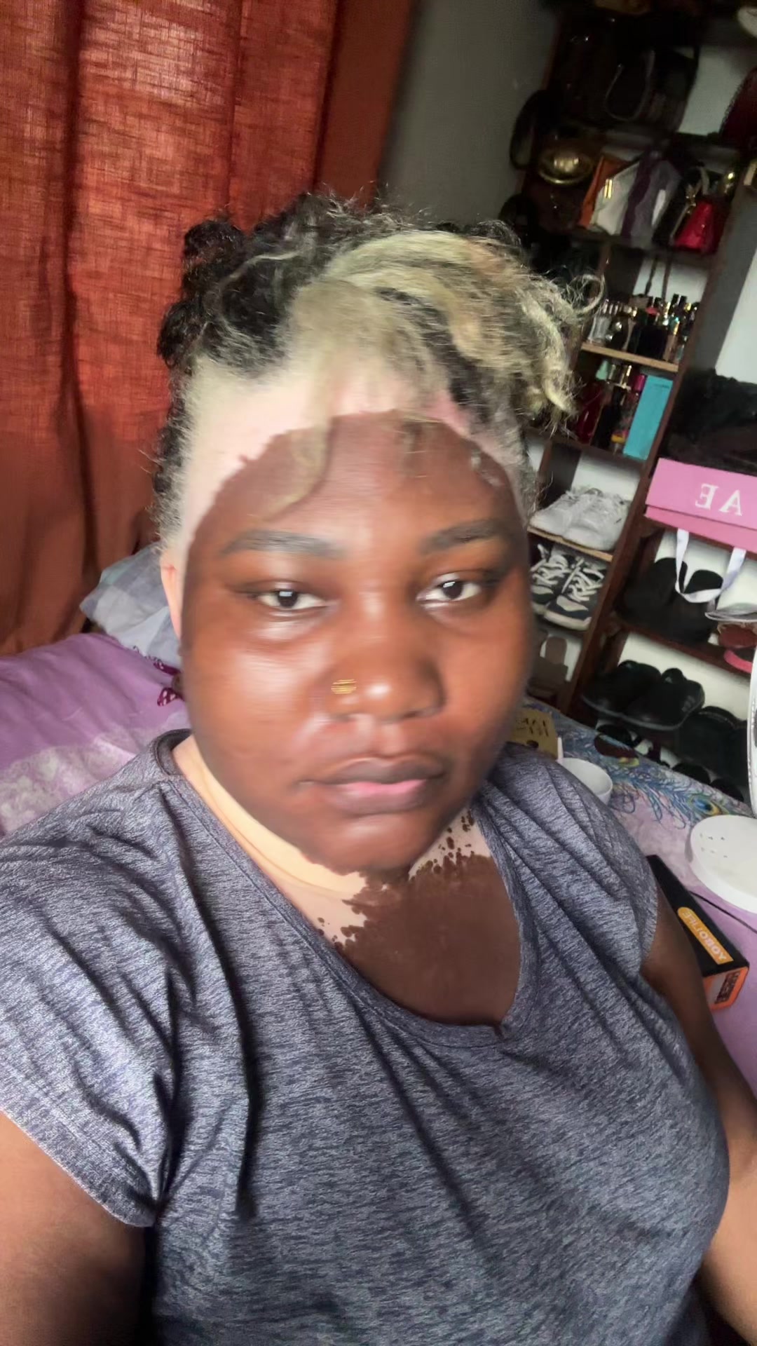 @Thevitiligogirl