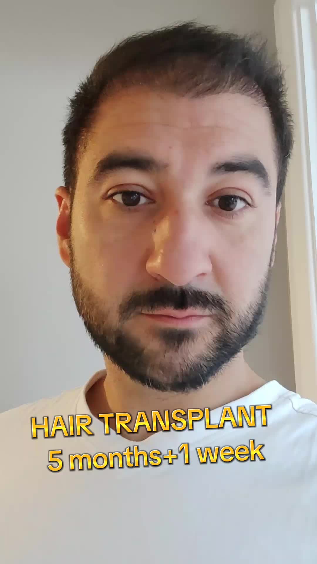 @My hair transplant