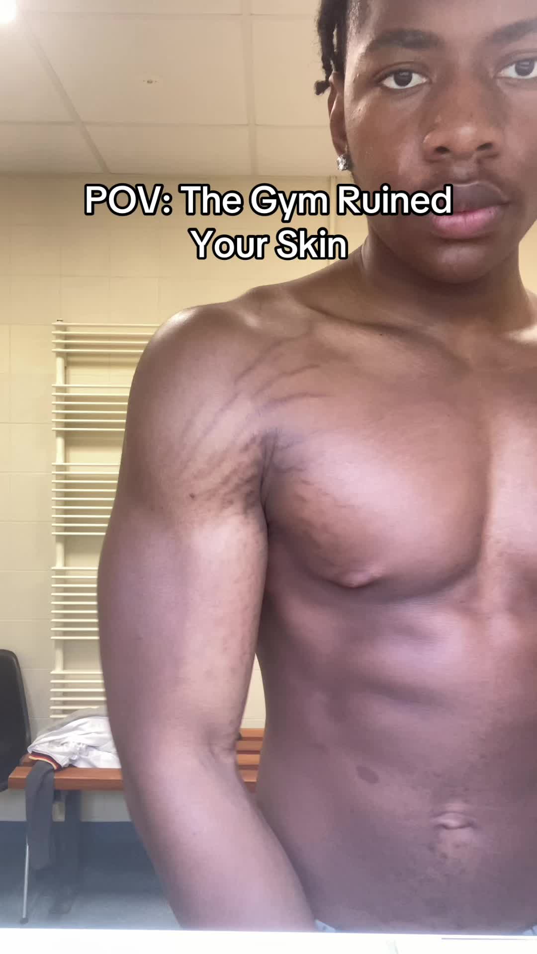 @Stretch marks guy