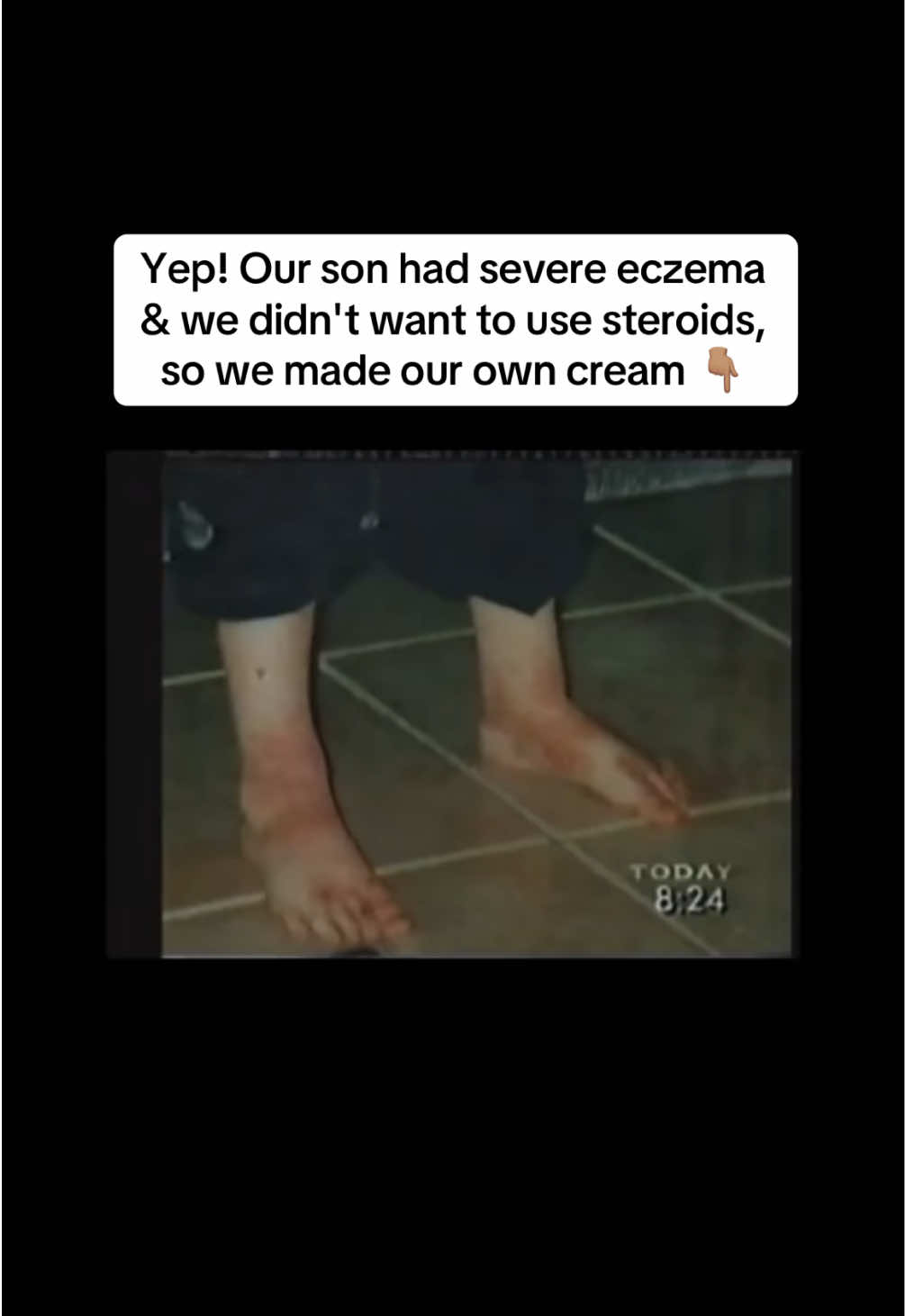 @Eczema Diaries USA & UK
