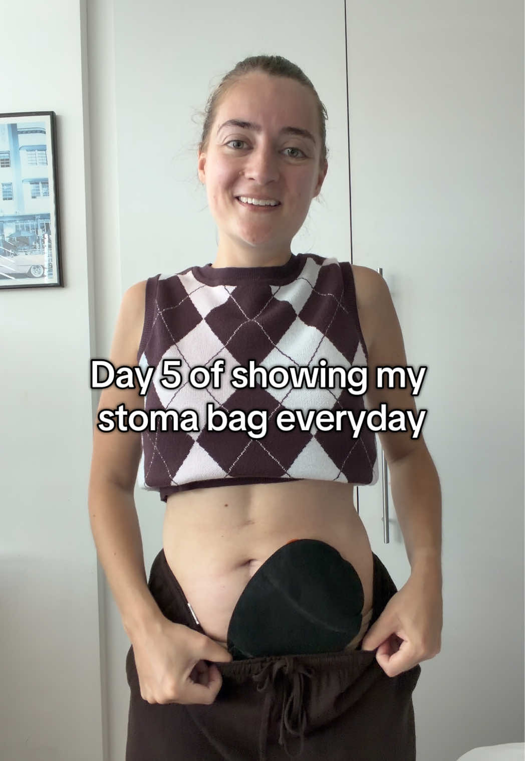 @Louise | Stoma & Crohns