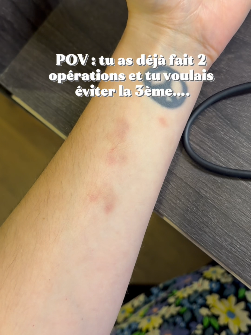 @Vivi-lipoedema