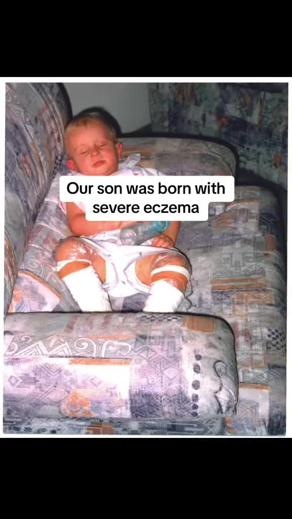 @Eczema Diaries USA & UK