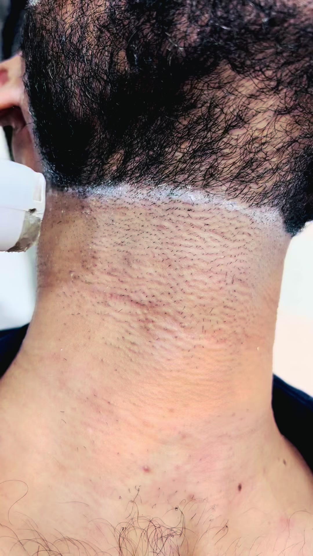 @Laser Grafix clinic