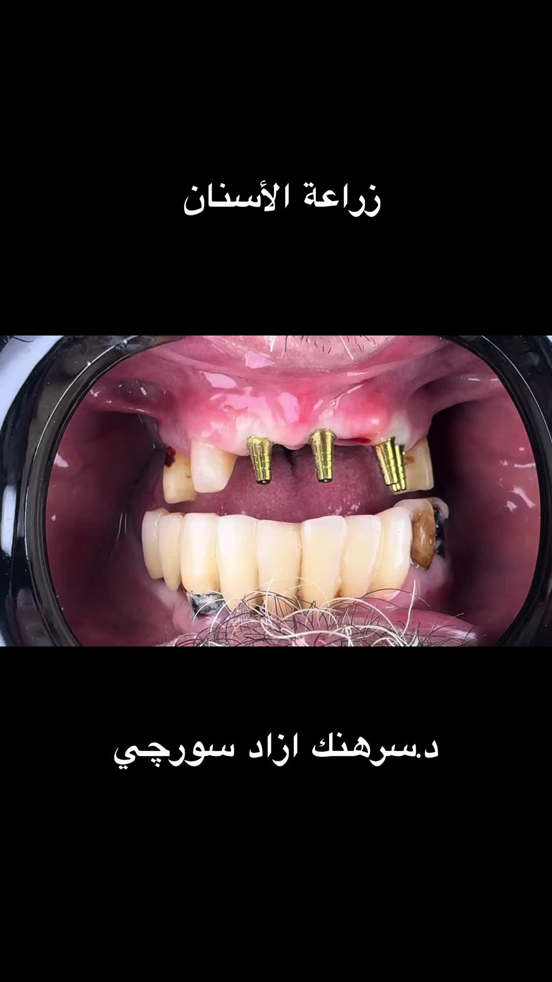 @Dr.Sarhang Surchi