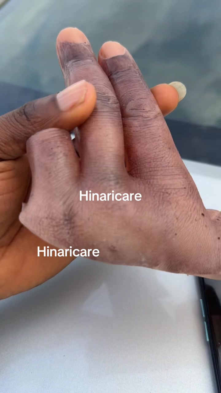 @Hinaricare prosthetics