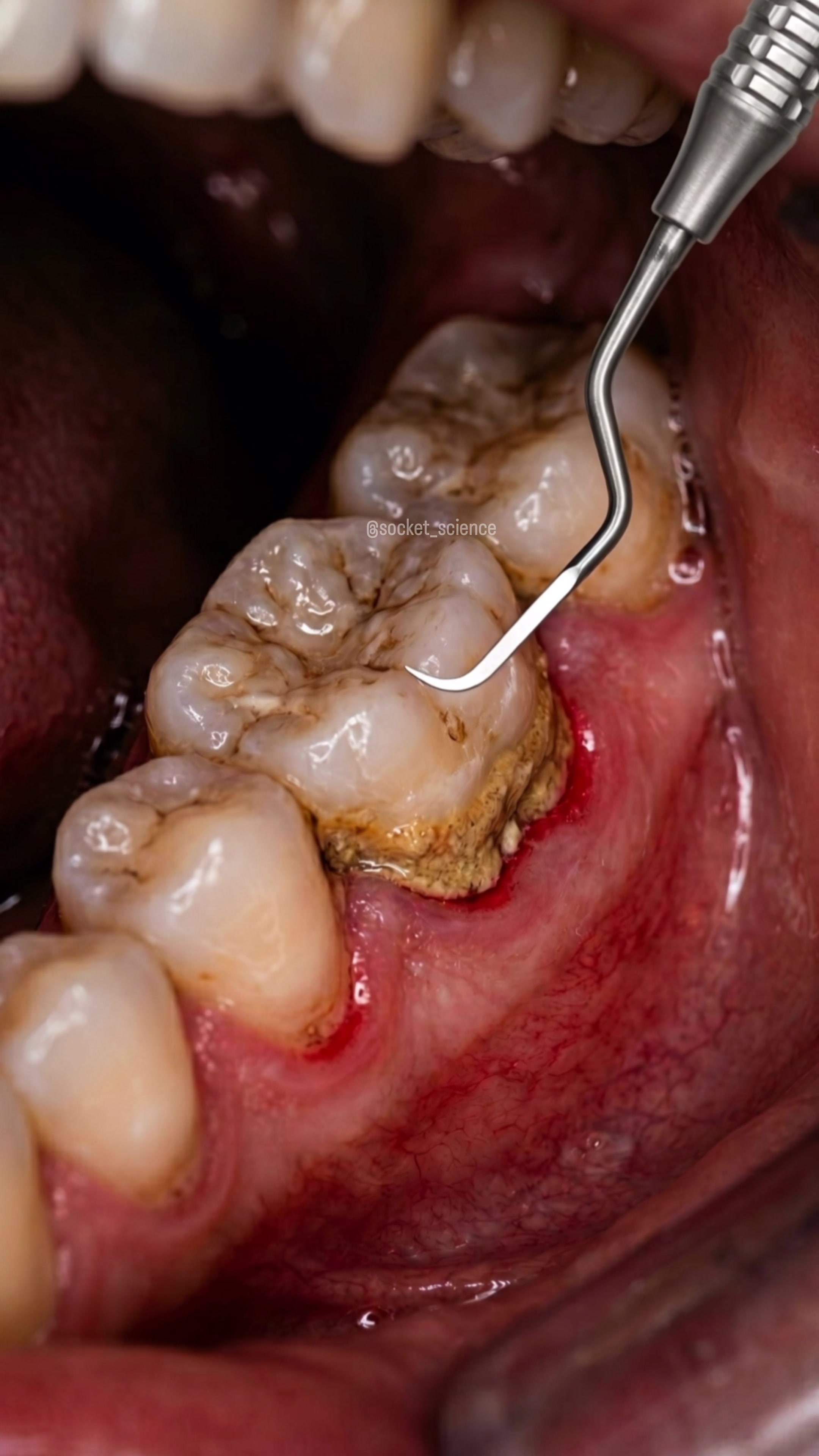 @Socket Science | Dental Visual