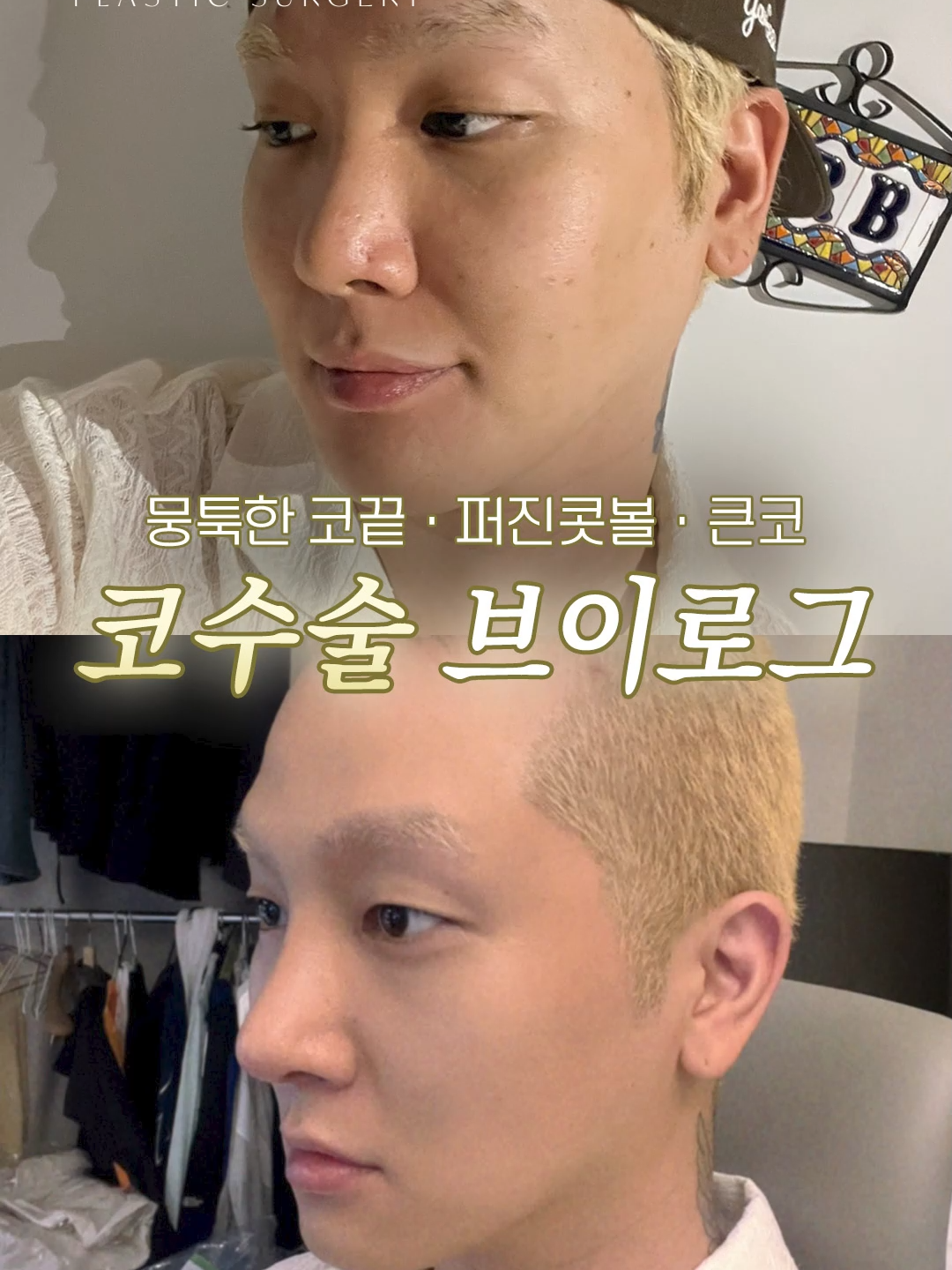 @리셋성형외과