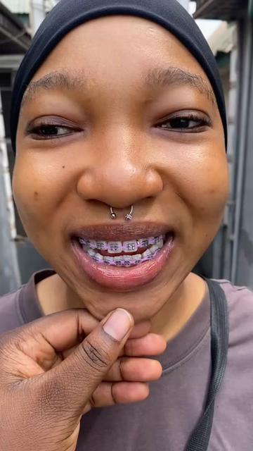 @Braces.bymavi|Smile Aesthetics