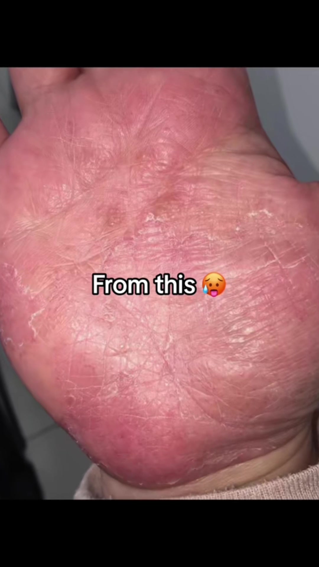 @Eczema Diaries USA & UK