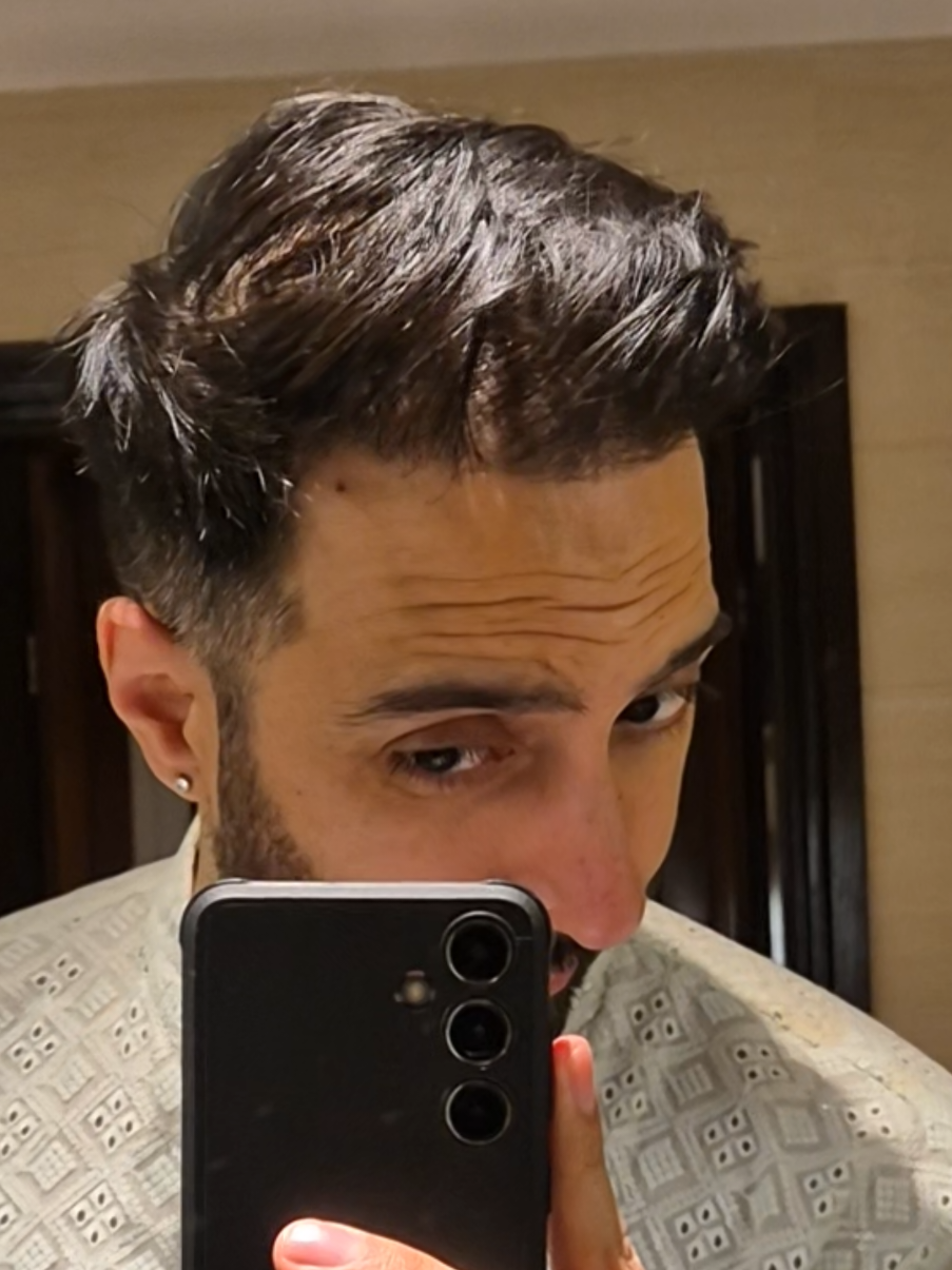 @Amit | Hair Transplant Tips