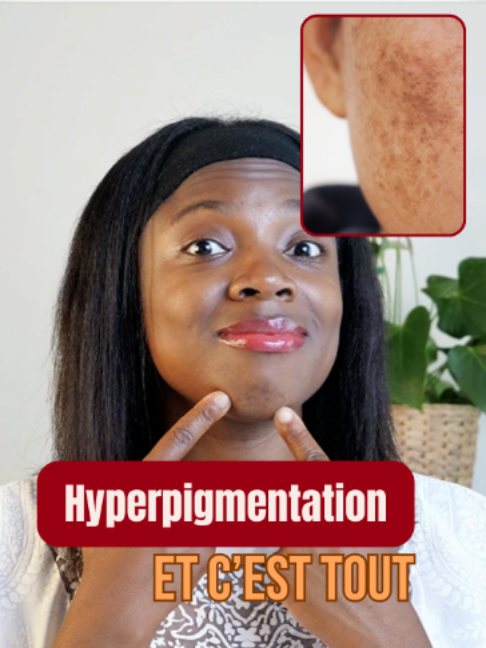 @Hyperpigmentation & Glow ✨