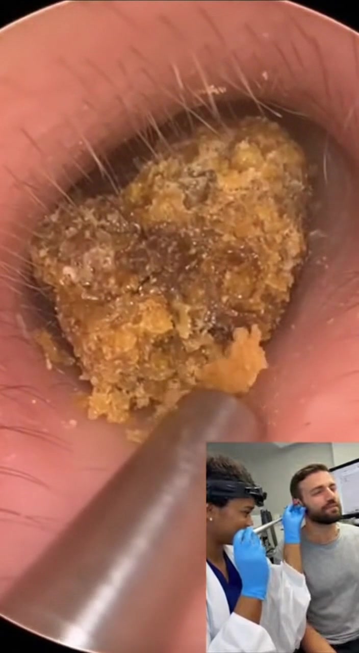 @Ear Cleaning