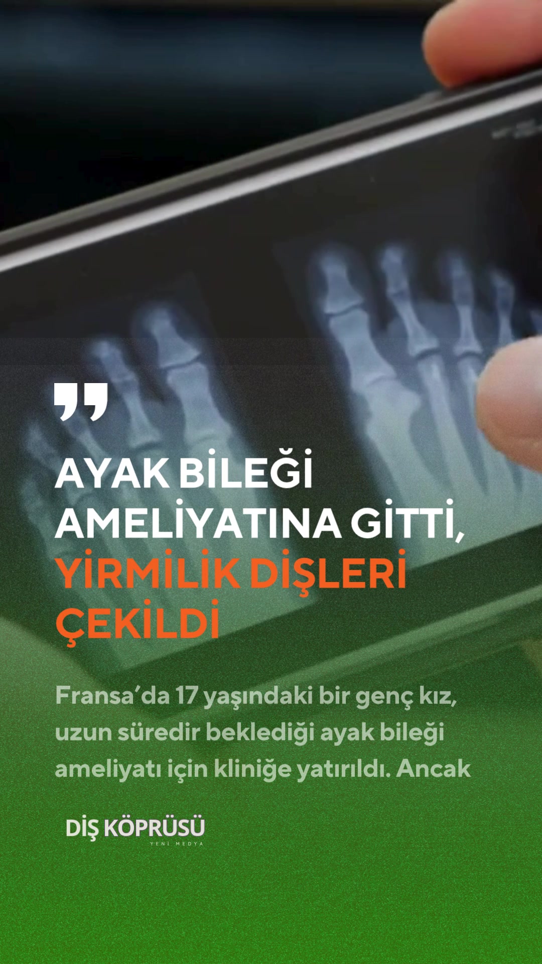 @Diş Köprüsü | Yeni Medya