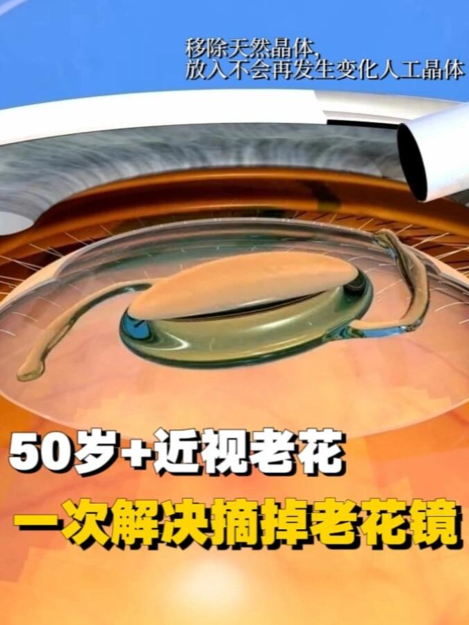 @🇺🇸西雅图/波特兰 King  Lasik 近视老花手术