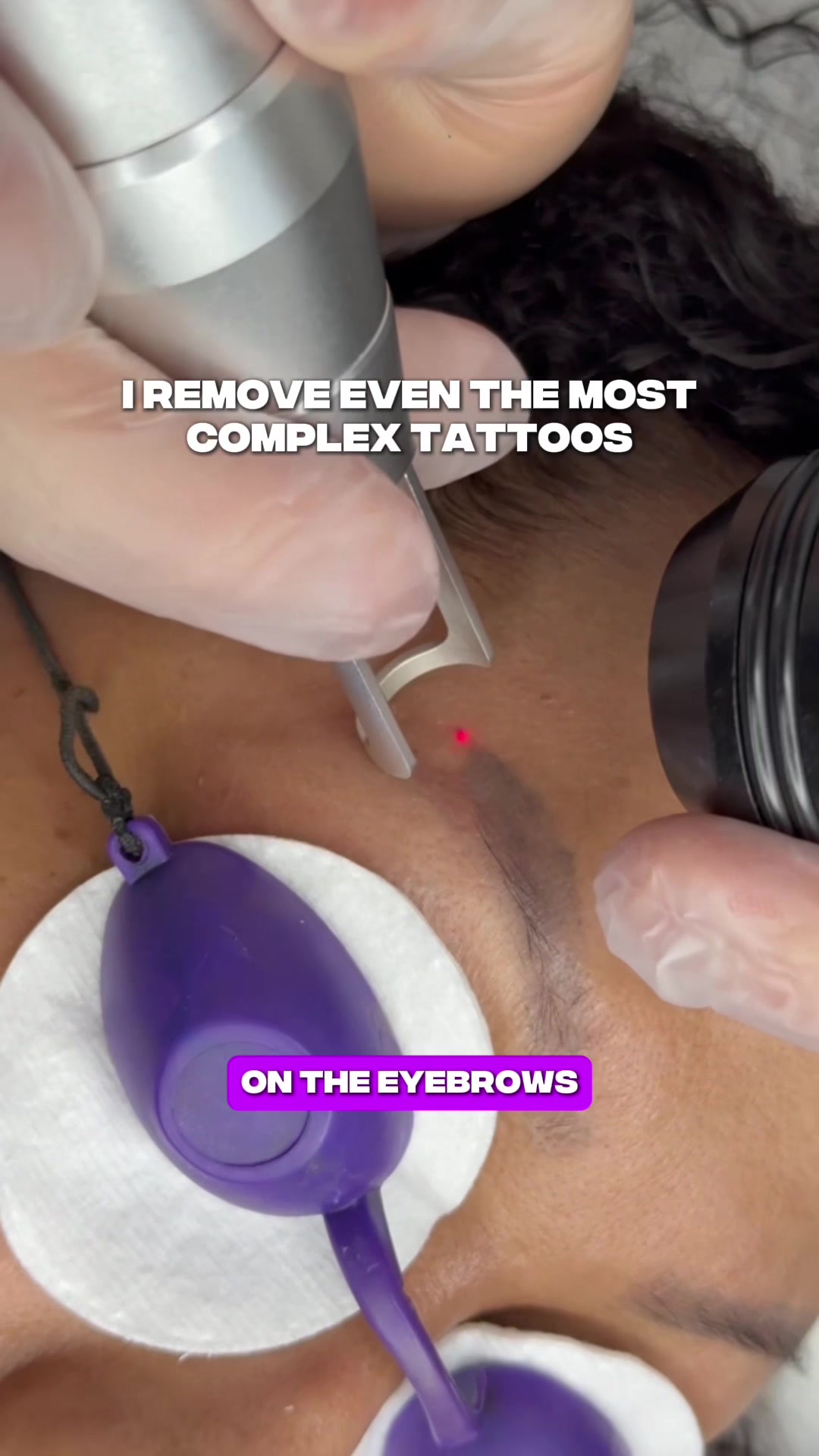 @Safe Eyebrows Tattoo Removal🗽