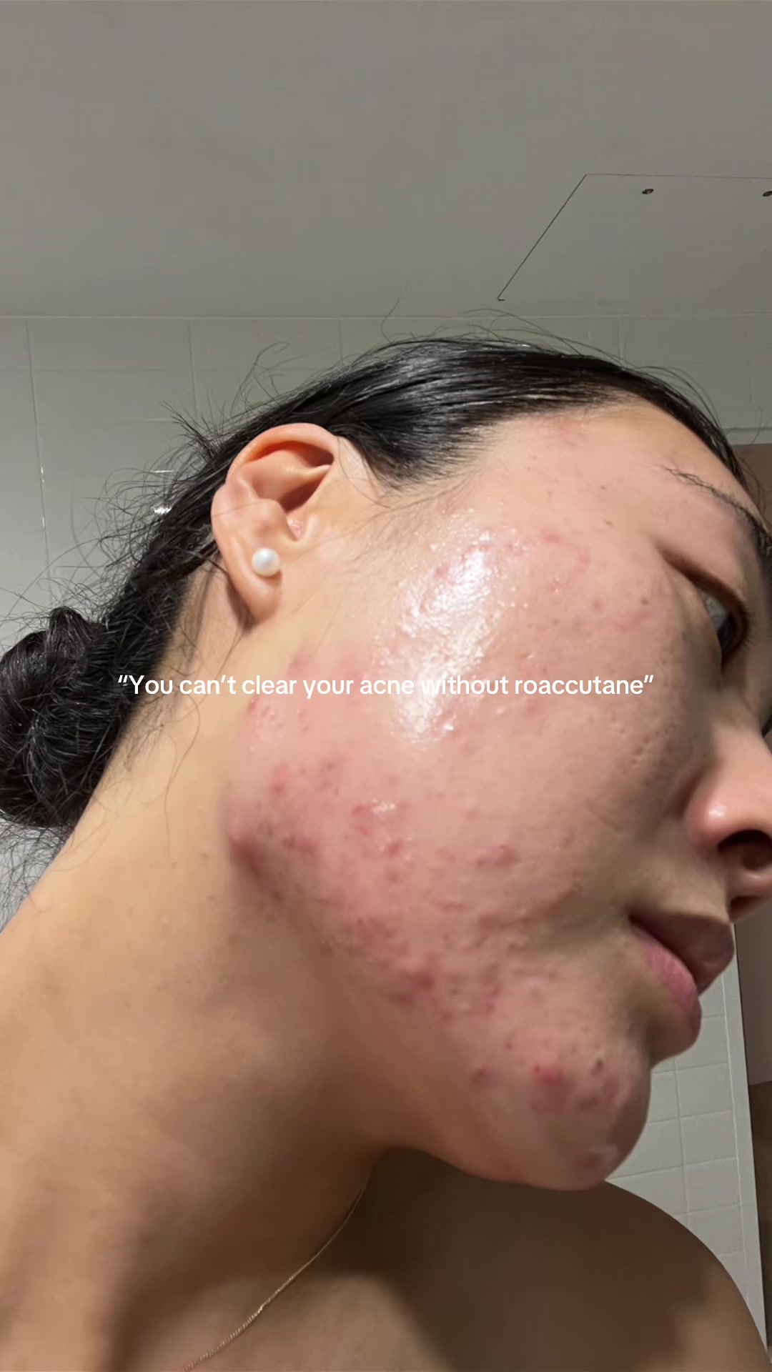 @Lisa | acne → clear skin