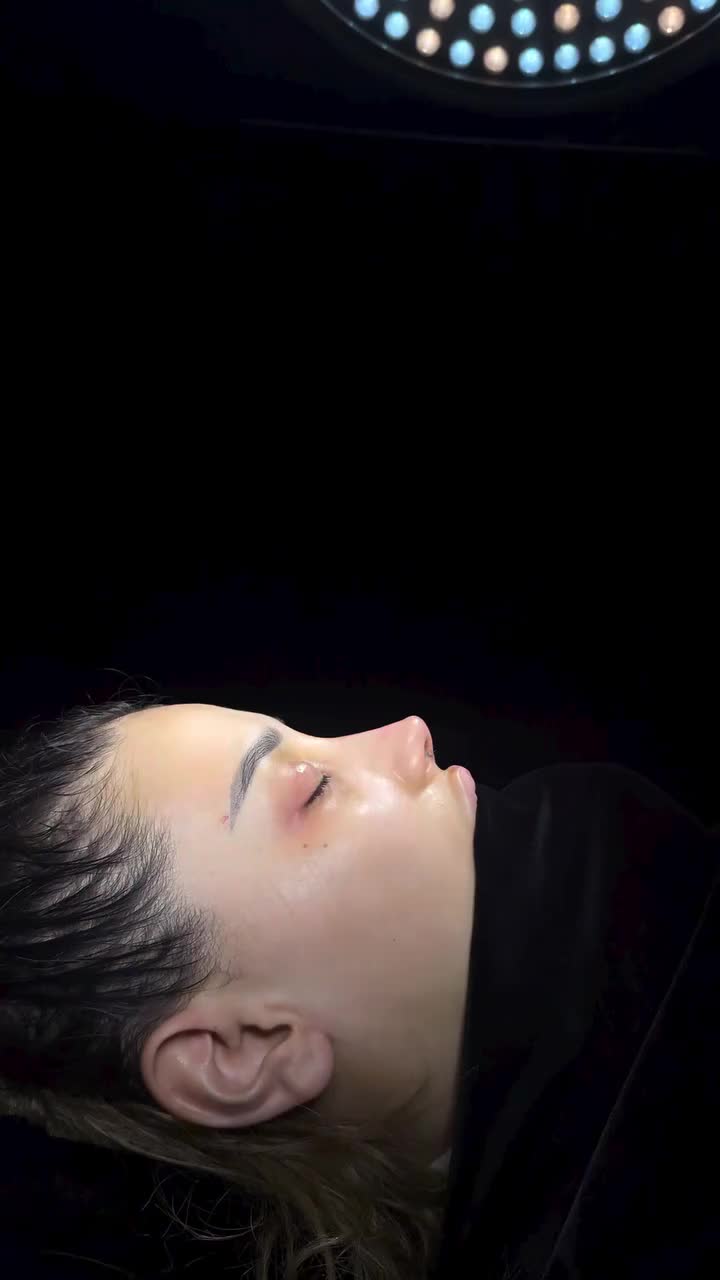 @Lor Cərrah Rinoplastika🌸✅