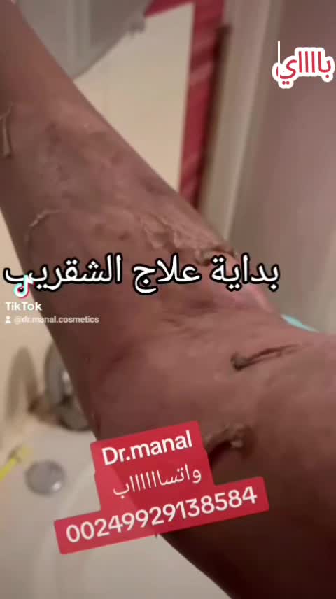 @drmanal " لعلاج التشققات "