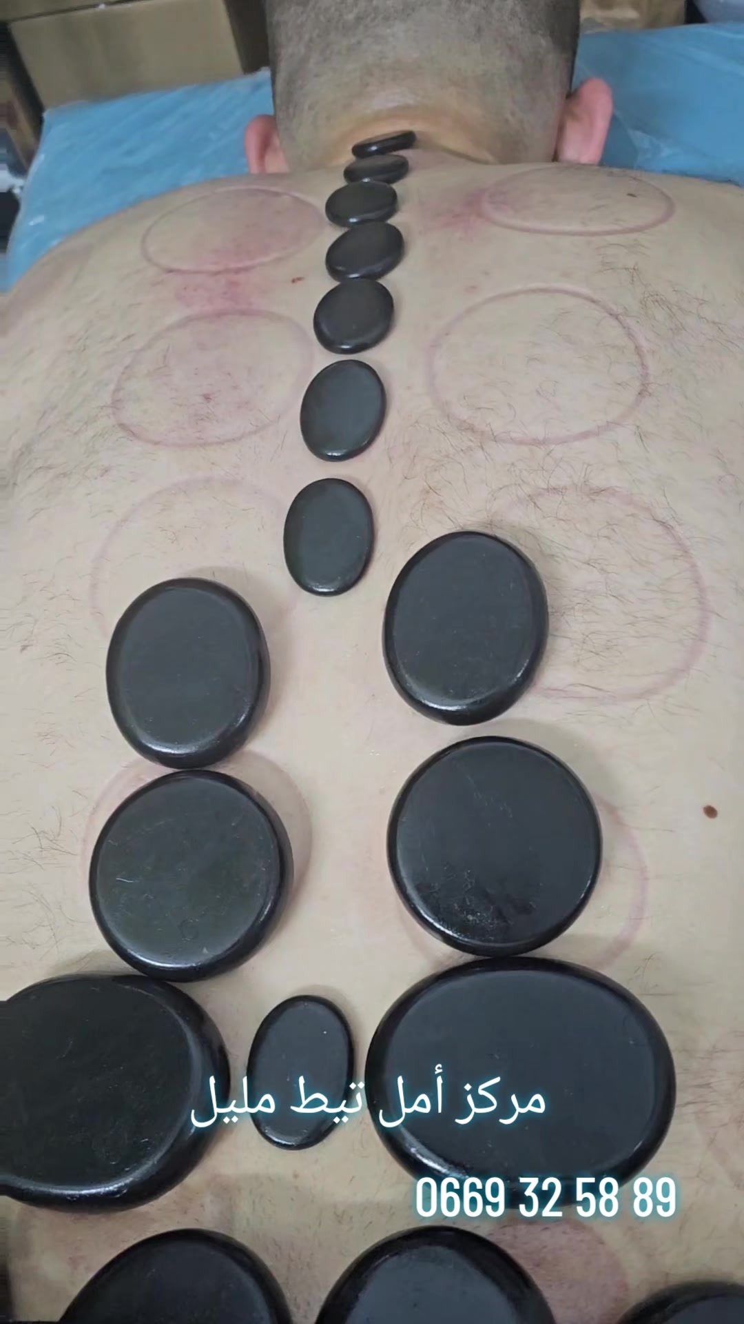 @Hijama_massage_Titmellil