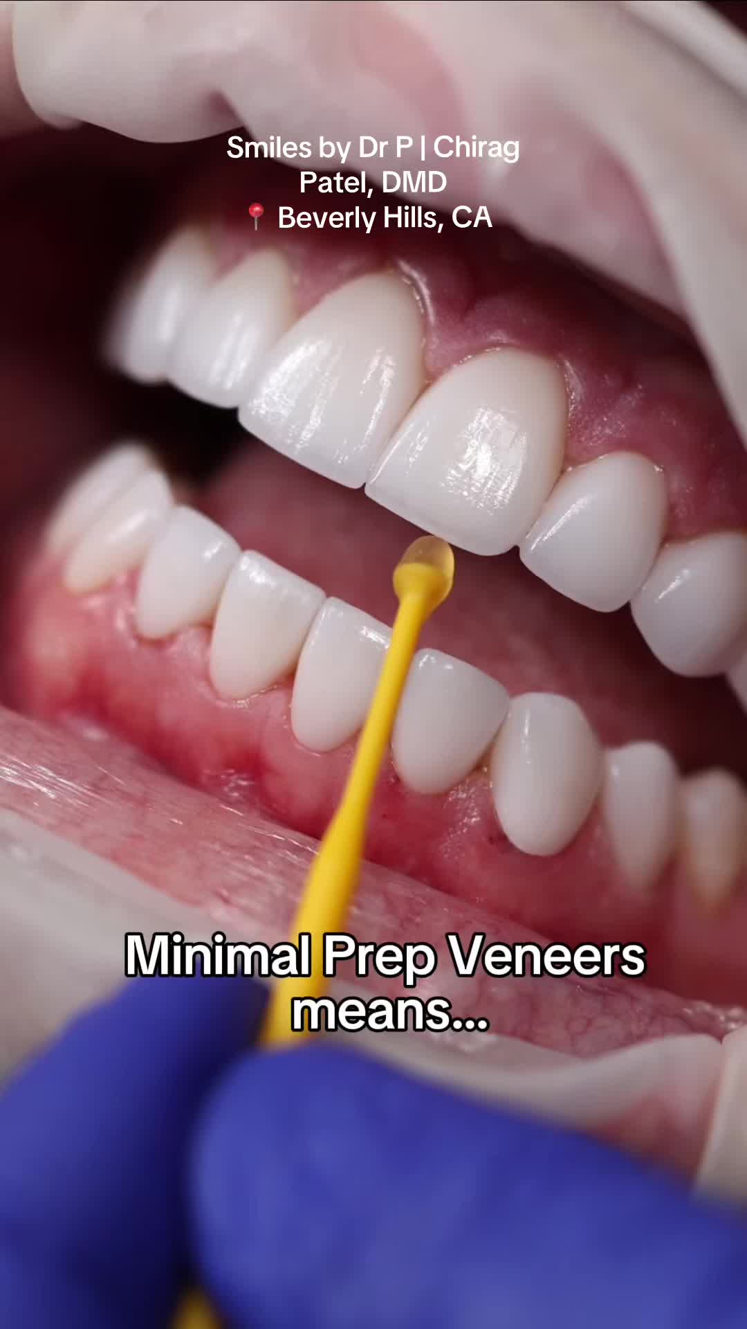 @Veneers