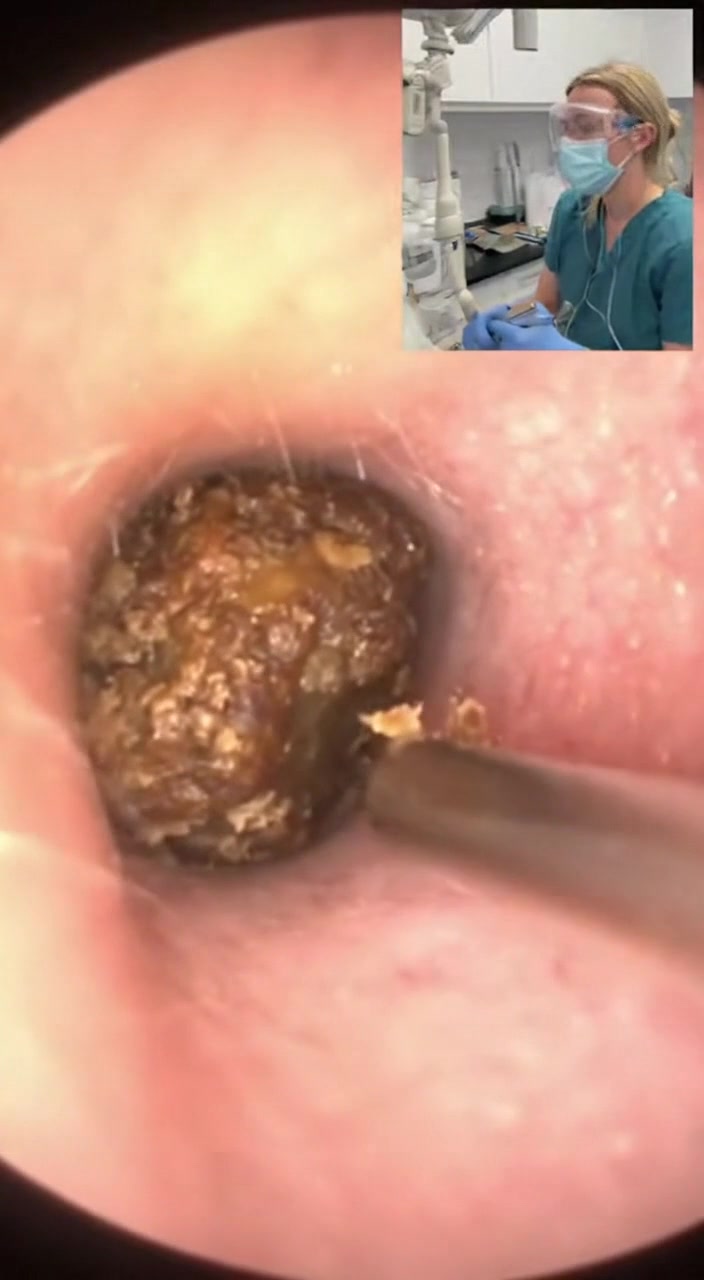 @Ear Cleaning
