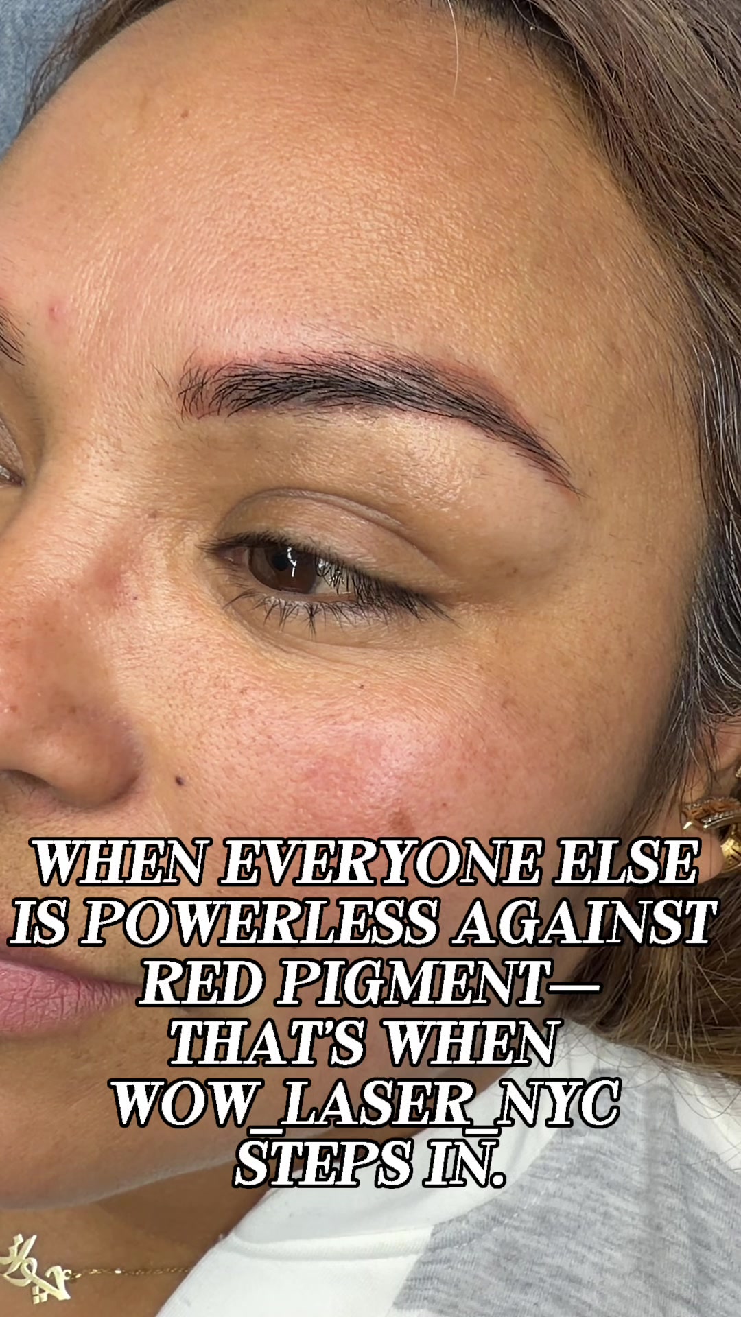 @Safe Eyebrows Tattoo Removal🗽