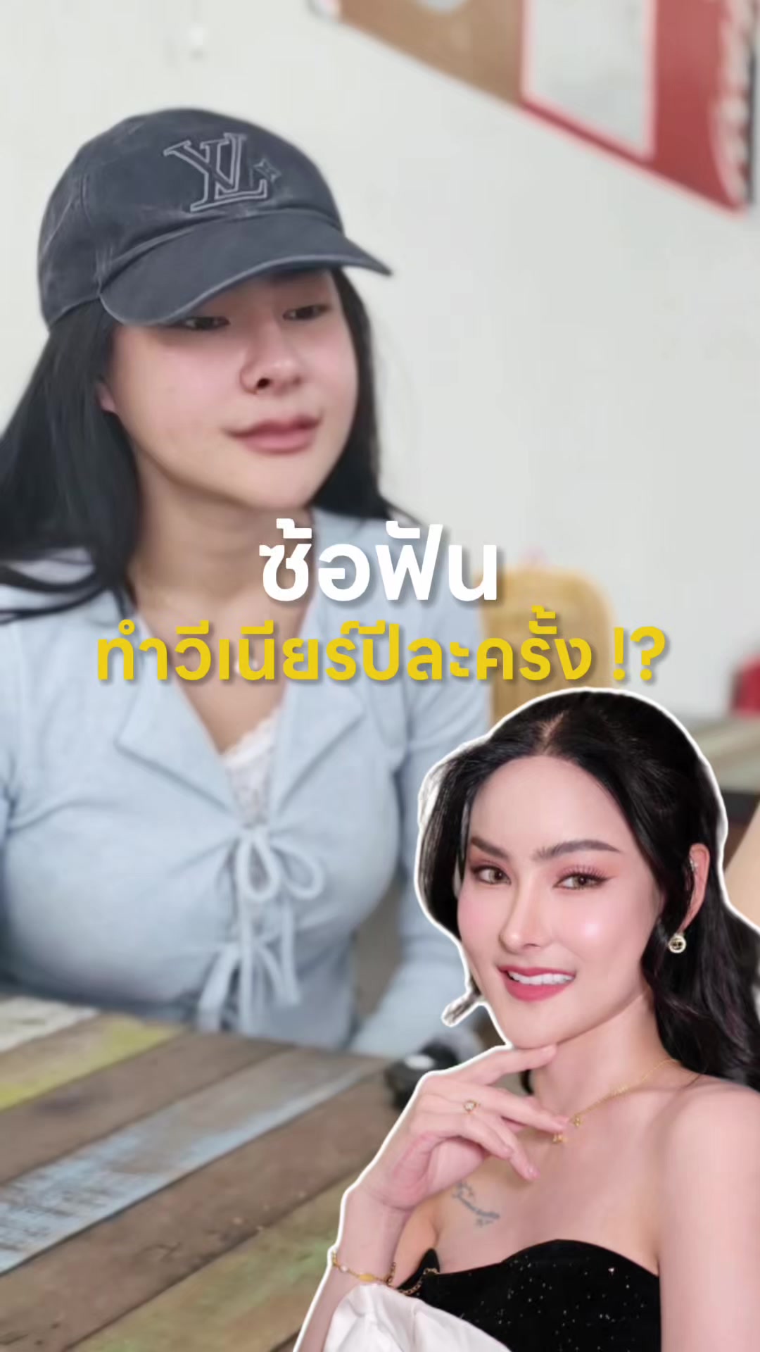 @หมอป่องสวยมาก veneer 🦷