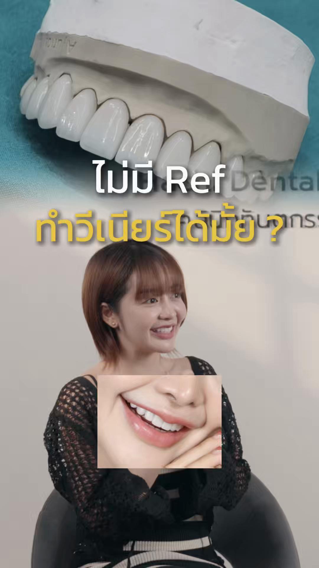 @หมอป่องสวยมาก veneer 🦷
