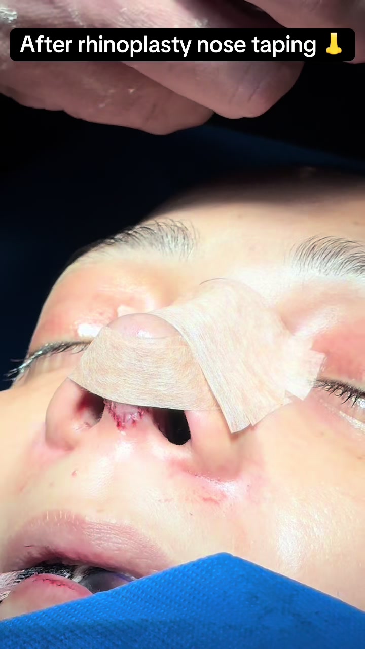 @Rhinoplastyhub clinic222