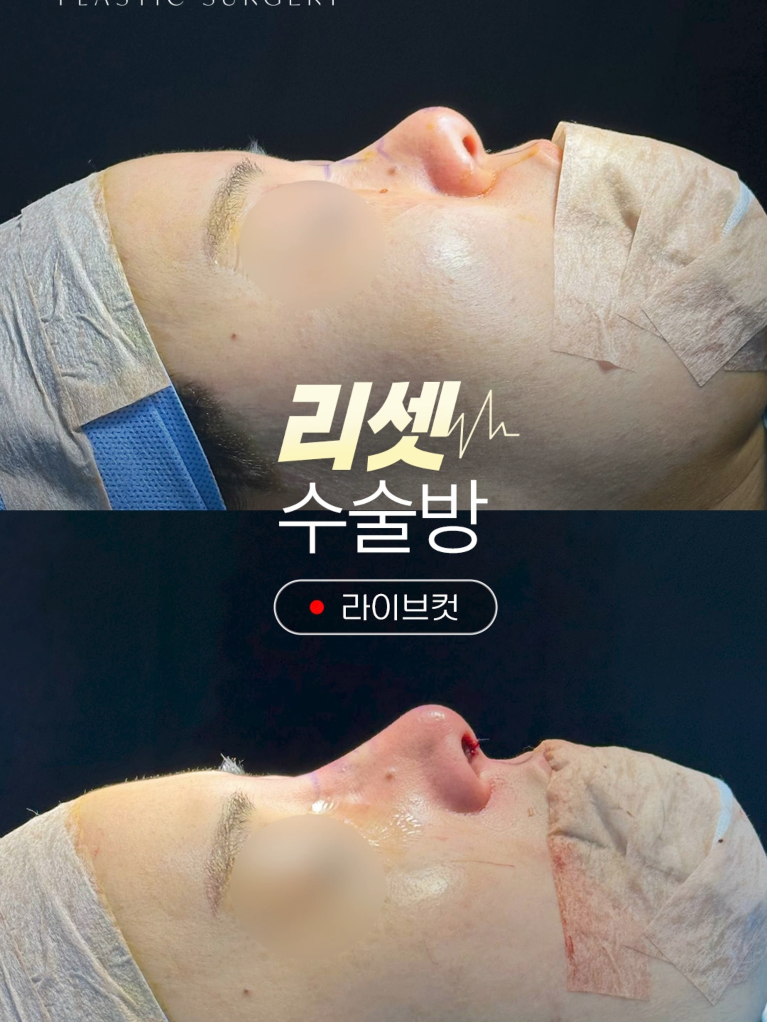 @리셋성형외과