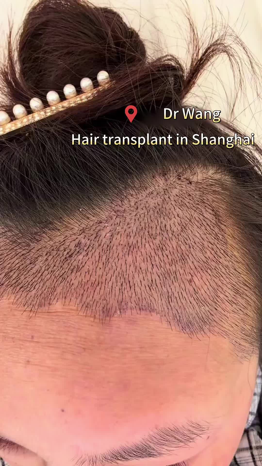 @HAIR TRANSPLANT WANG🇨🇳