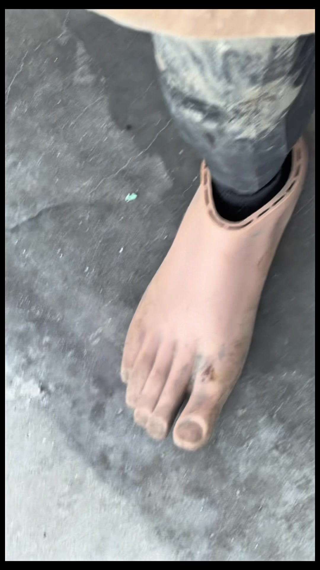 @Limb Loss Boss