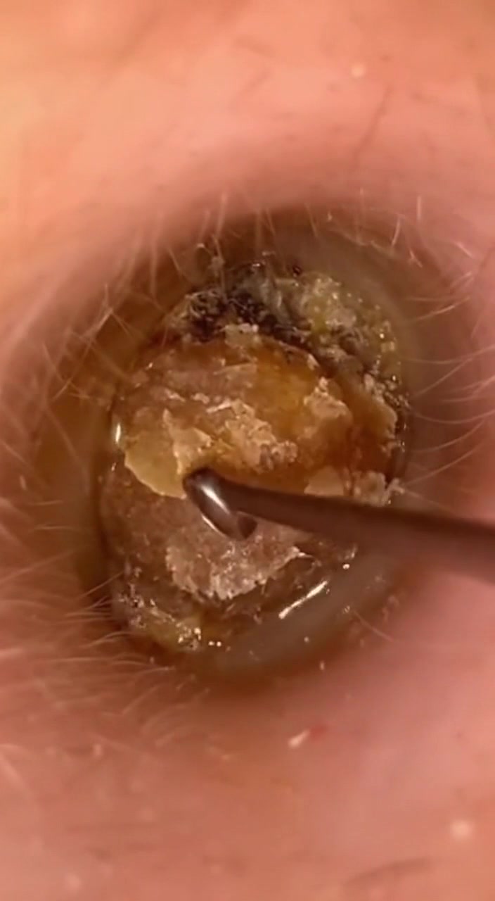 @Ear Cleaning